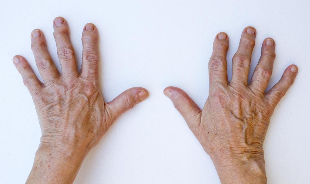 The MCP joints are less vulnerable to injury than the interphalangeal joints in the fingers.