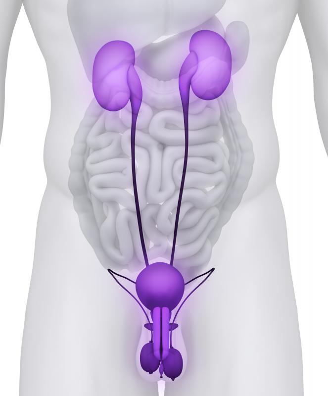 The formation of kidney stones in the ureters is referred to as ureterolithiasis.