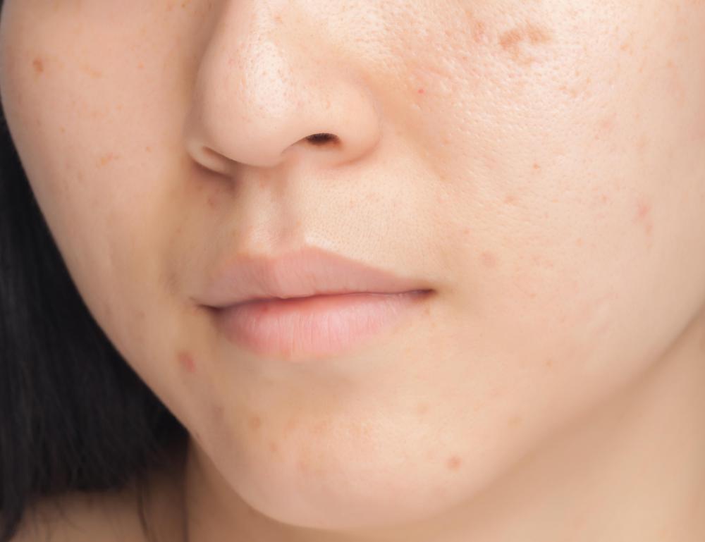 Enlarged pores may lead to acne.