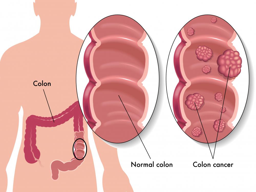 The over-expression of MUC1 is linked to colon cancer.