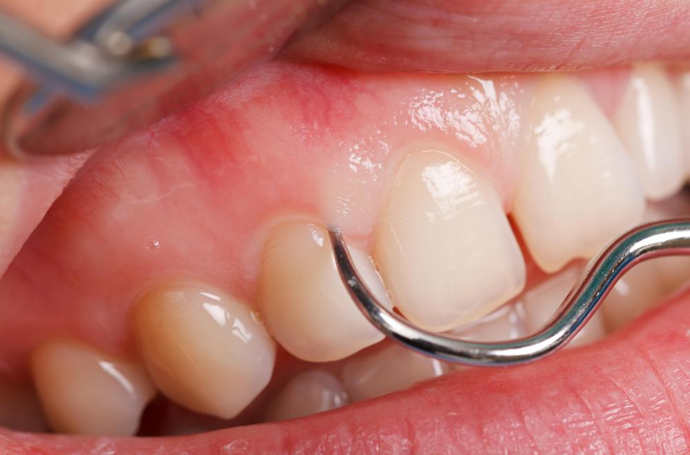 Aside from tender gums, scurvy can cause loosened teeth and swelling and bleeding in the gums.