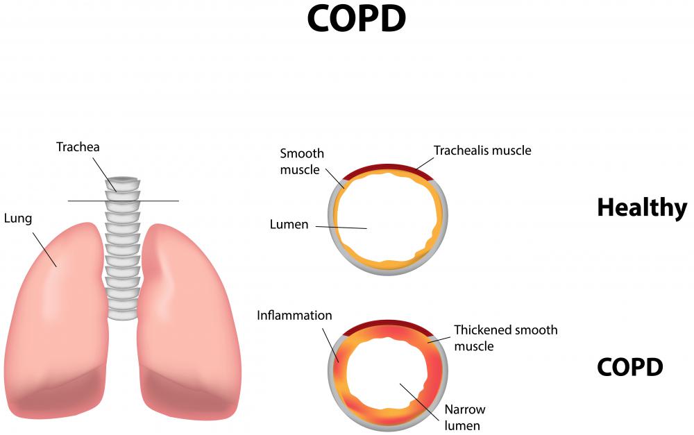 COPD can cause a high red blood cell count.