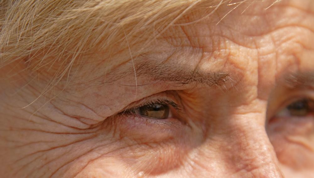Frequent use of the zygomaticus muscle can lead to crow's feet.