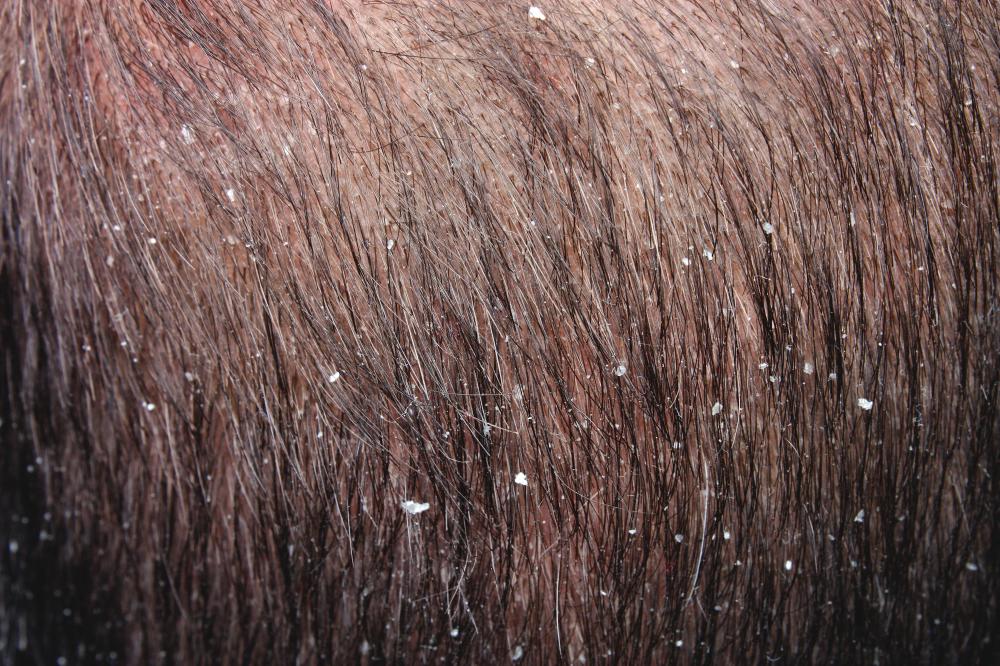 One of the main uses of silica is preventing dandruff.