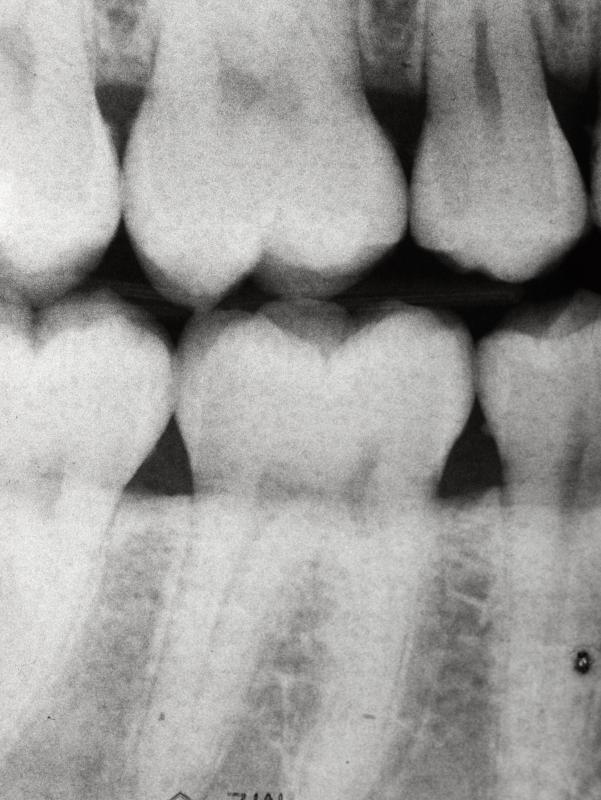 A dental X-ray, including a bicuspid.