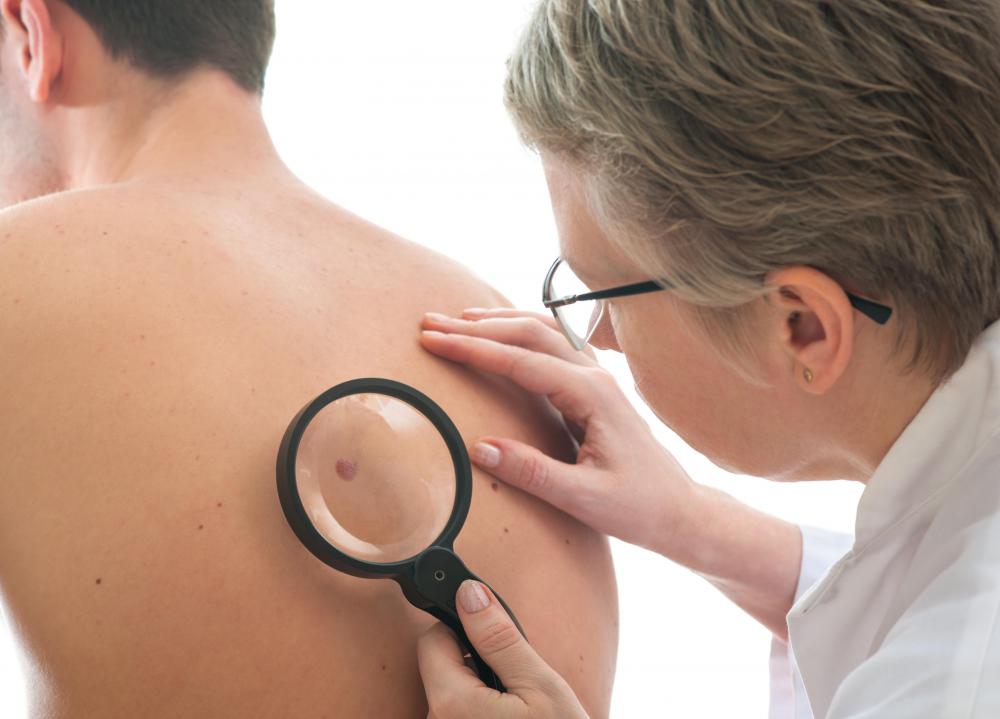 Dermatologists are often called upon to remove moles.