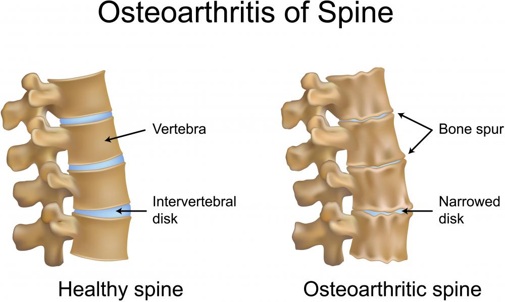 BME can be triggered by osteoarthritis.