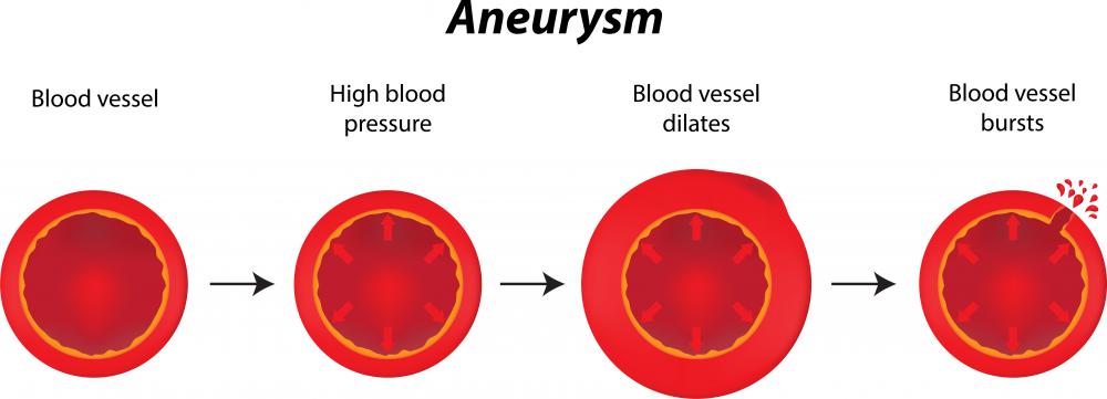 Aneurysm is a type of vascular tone dysfunction.