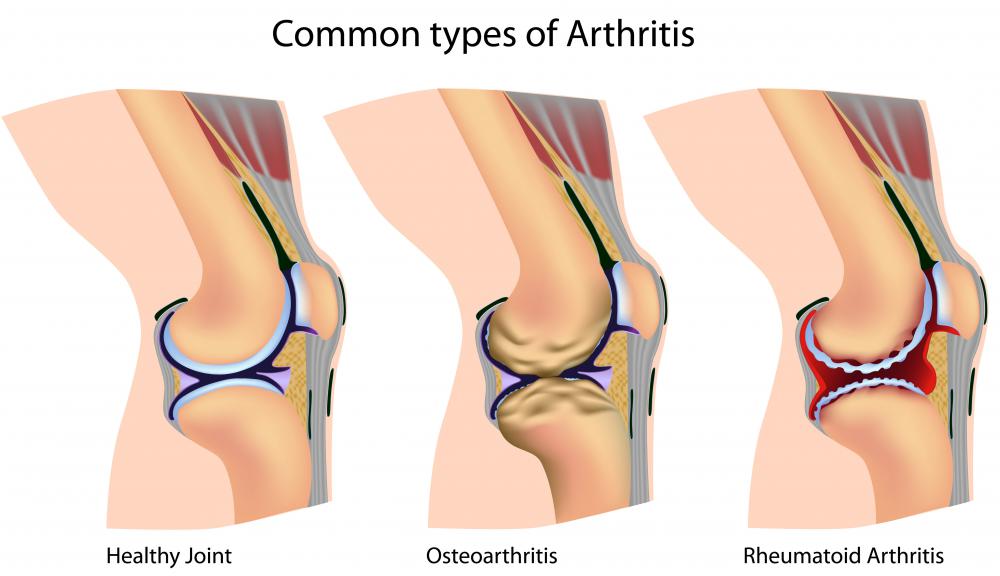 A diagram of arthritis' effect on the knee joint.