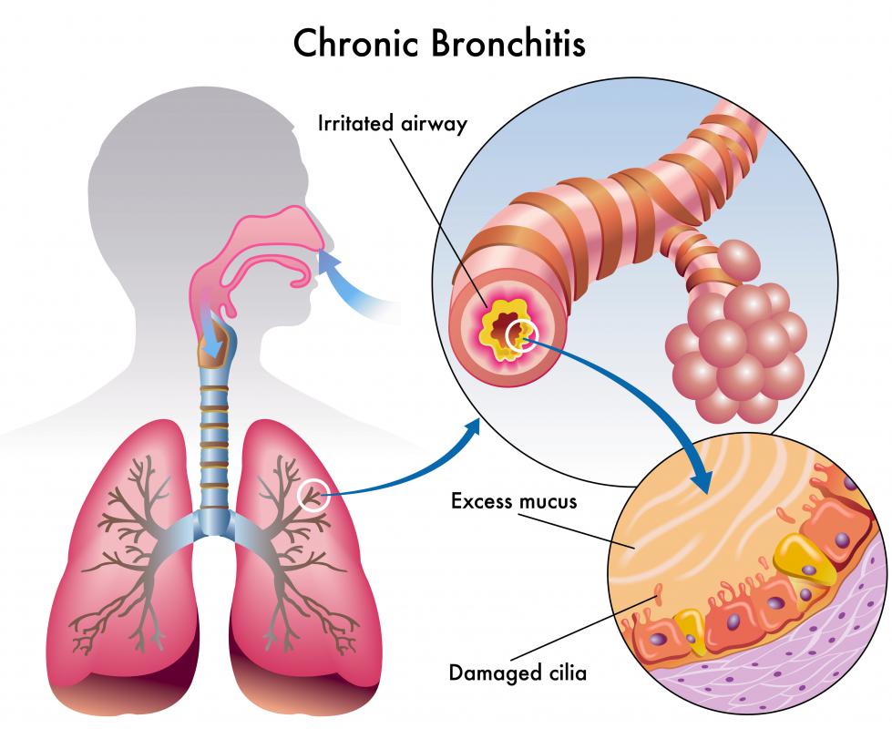 Common causes of a lung infection include bronchitis.
