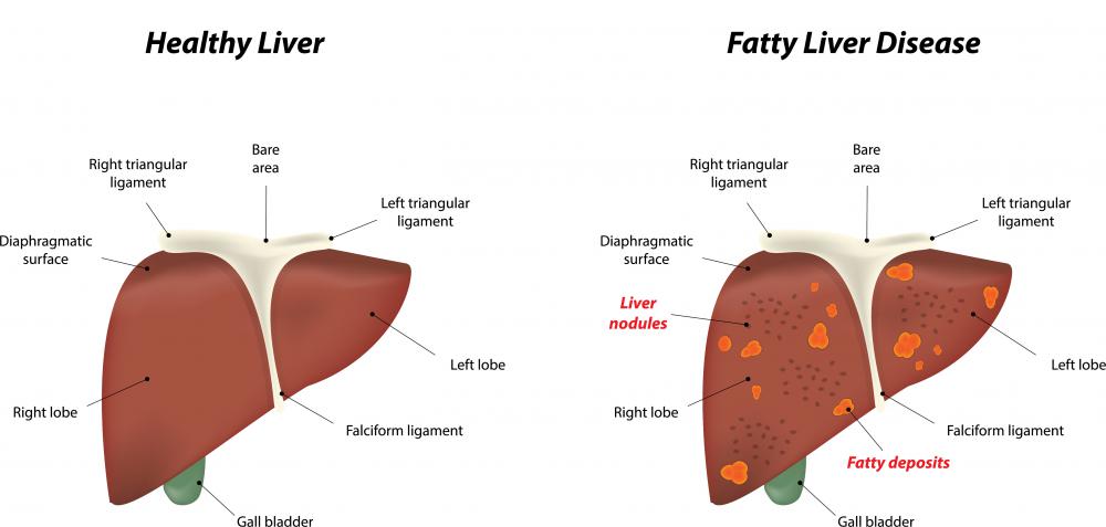 People suffering from liver disease may experience rouleaux.