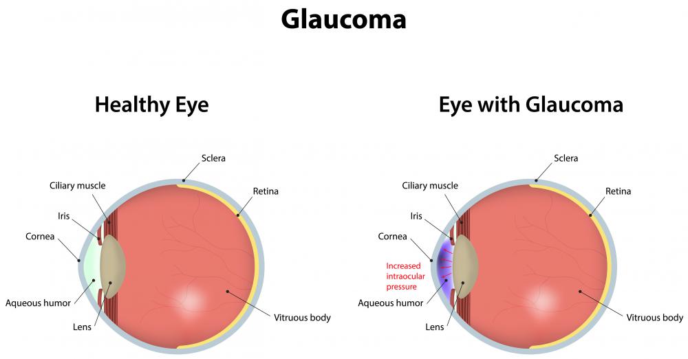 Hydrocortisone valerate cream used near the eyes can lead to glaucoma or make existing glaucoma worse.