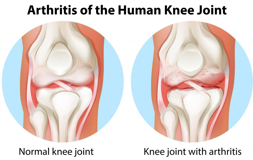 A popliteal cyst in the knee may be associated with underlying arthritis.