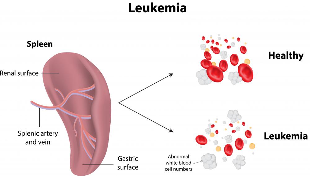 Spleen disorders can be as serious as leukemia.