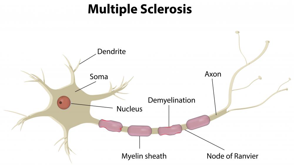 Hand spasms may occur as a result of multiple sclerosis.