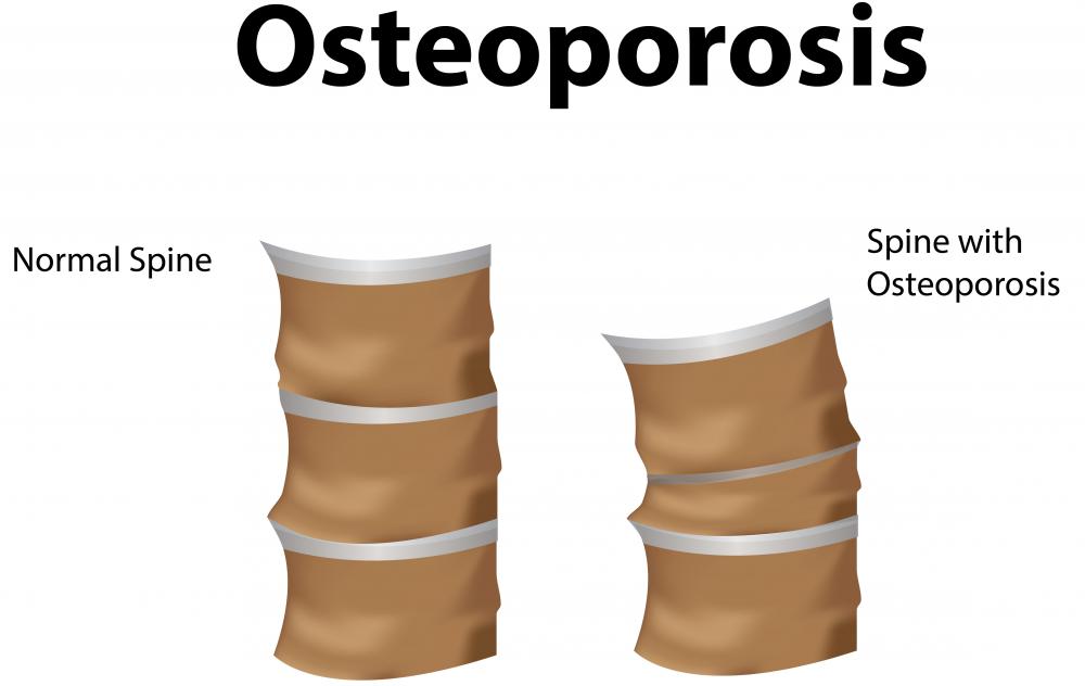Chronic issues like osteoporosis can contribute to spinal stenosis.