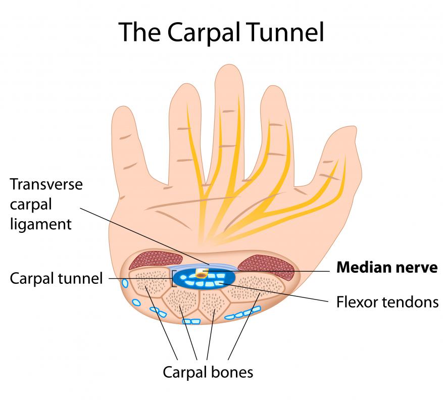 Flexor tendons in the hand become inflammed in flexor tenosynovitis.
