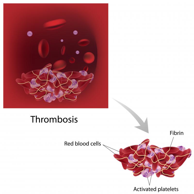 Renal vein thrombosis occurs when a blood clot forms in the renal vein and obstructs the outflow of blood from the kidney.