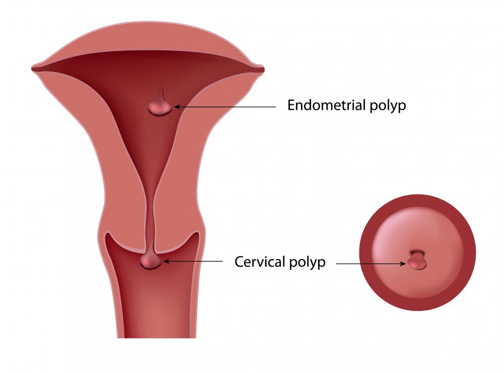 A cervical polyp might bleed because they are ruptured during intercourse.