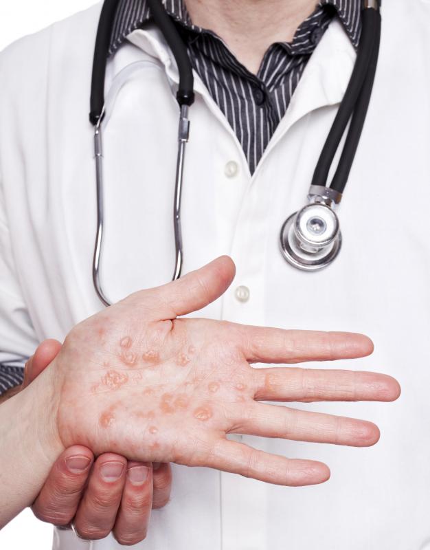 Local and systemic allergic reactions related to enoxaparin injection sites may include hives.