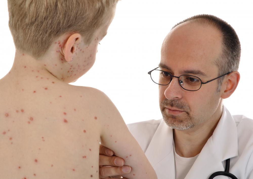 Chicken pox scars can be eliminated later in life.