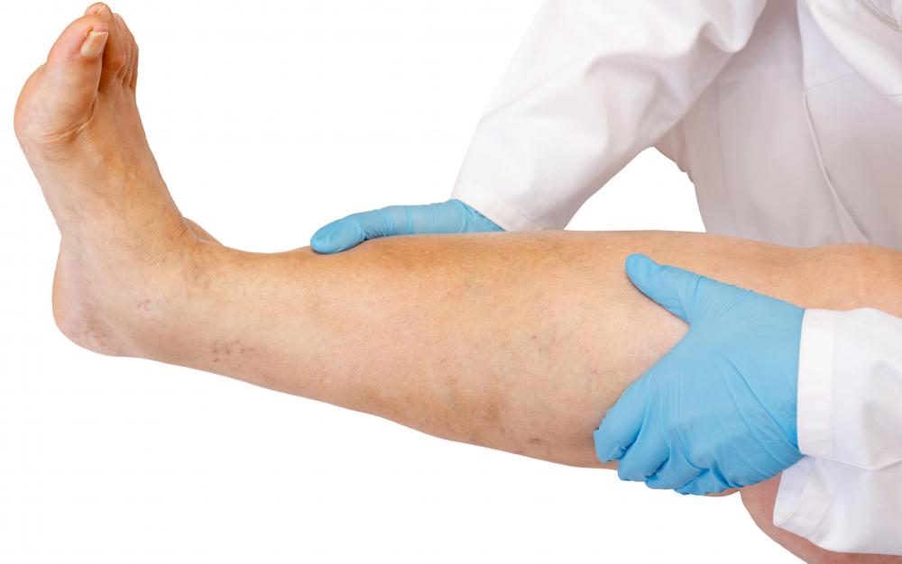 Problems with the lymphatic system may result in leg swelling.