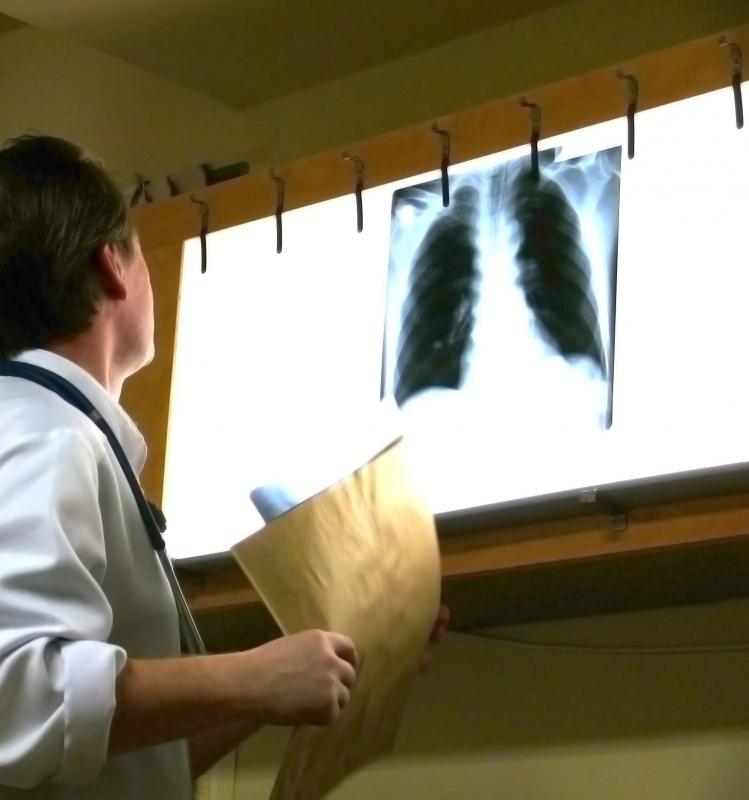 X-rays may help doctors determine if the absence of a fatty filter inside of a lymph node is due to calcification.