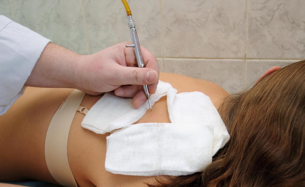 Doctors typically prefer to remove moles with any characteristics of being cancerous.