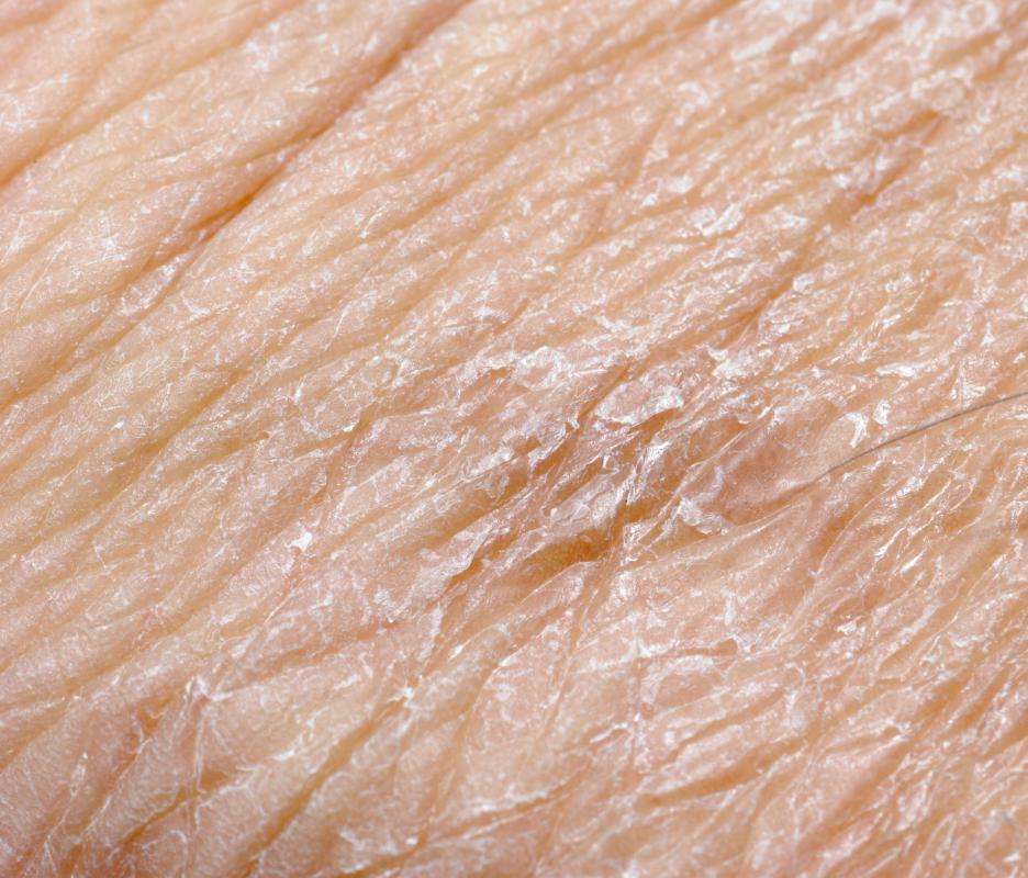 Ionized water can help relieve dry skin.