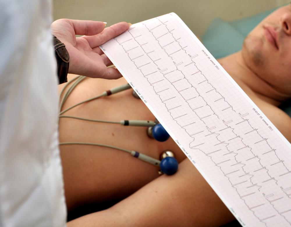 R waves are the upward spikes displayed on an electrocardiogram.