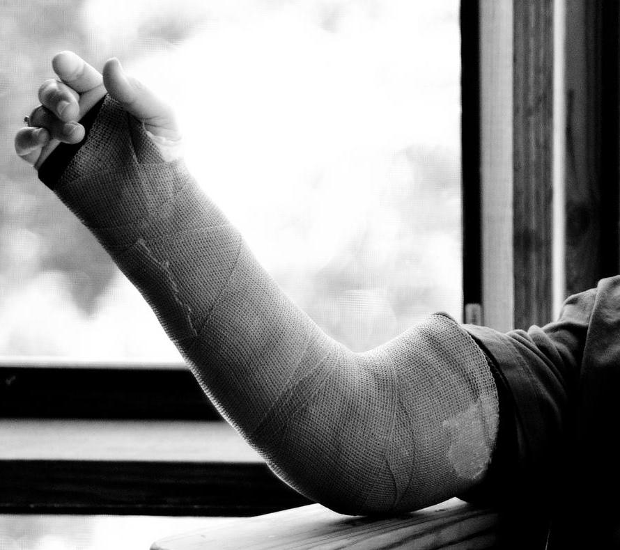A broken elbow may be treated with a cast.
