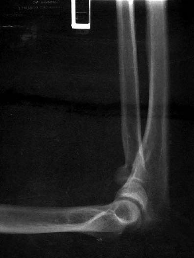 An x-ray of the elbow may be performed to diagnose elbow bursitis.