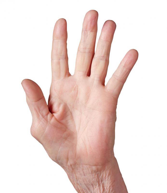 A hand with osteoarthritis.