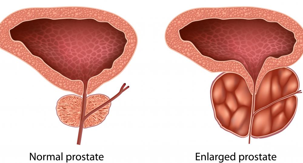 People with an enlarged prostate may need to take different levels of amitriptyline.