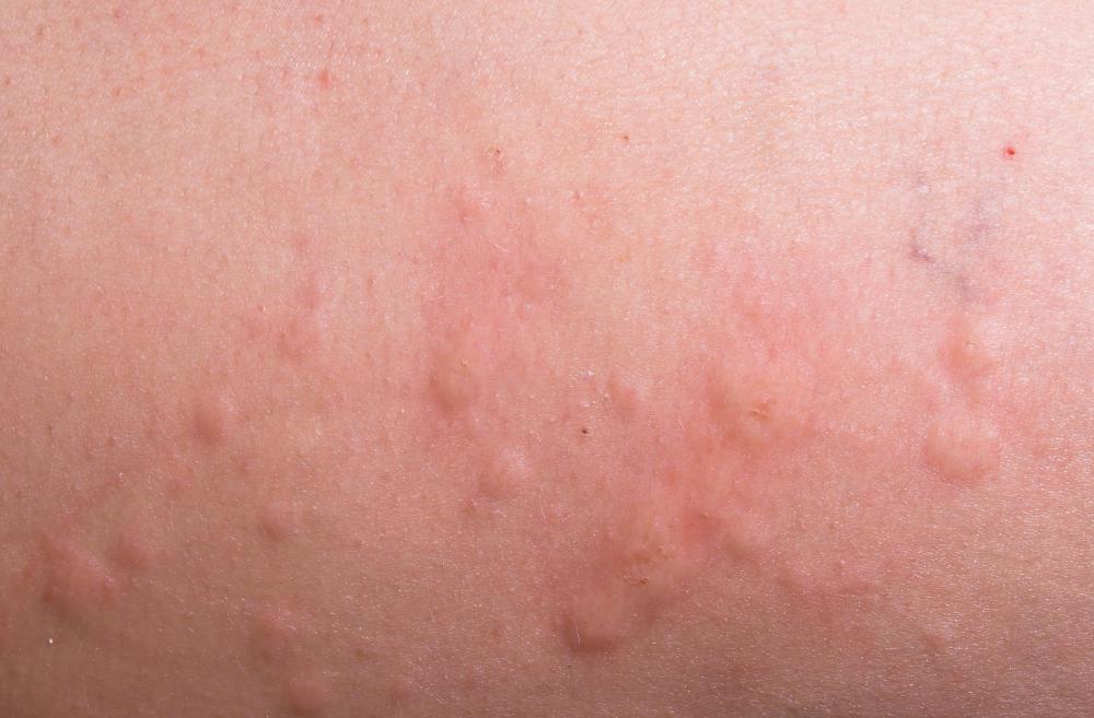 physical ailments, stress, and food allergies are all possible causes of hives.