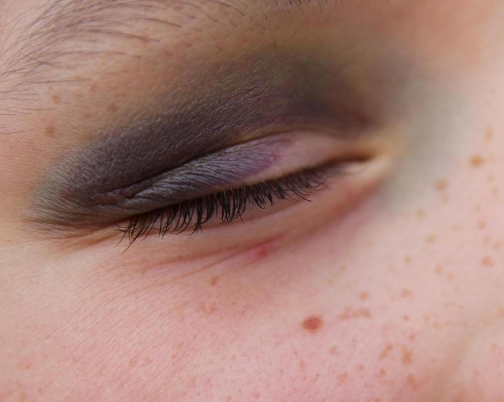 A bruised eye should be treated with ice immediately.
