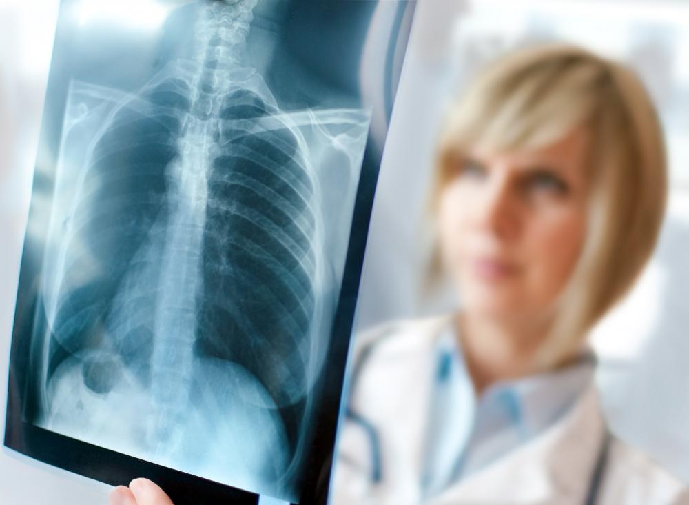 The xiphoid region can be dislodged or cracked by broken ribs.