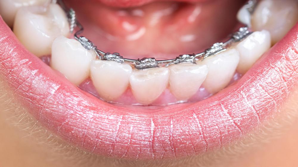 Braces can often be applied in order to shift the teeth forward into the proper position.