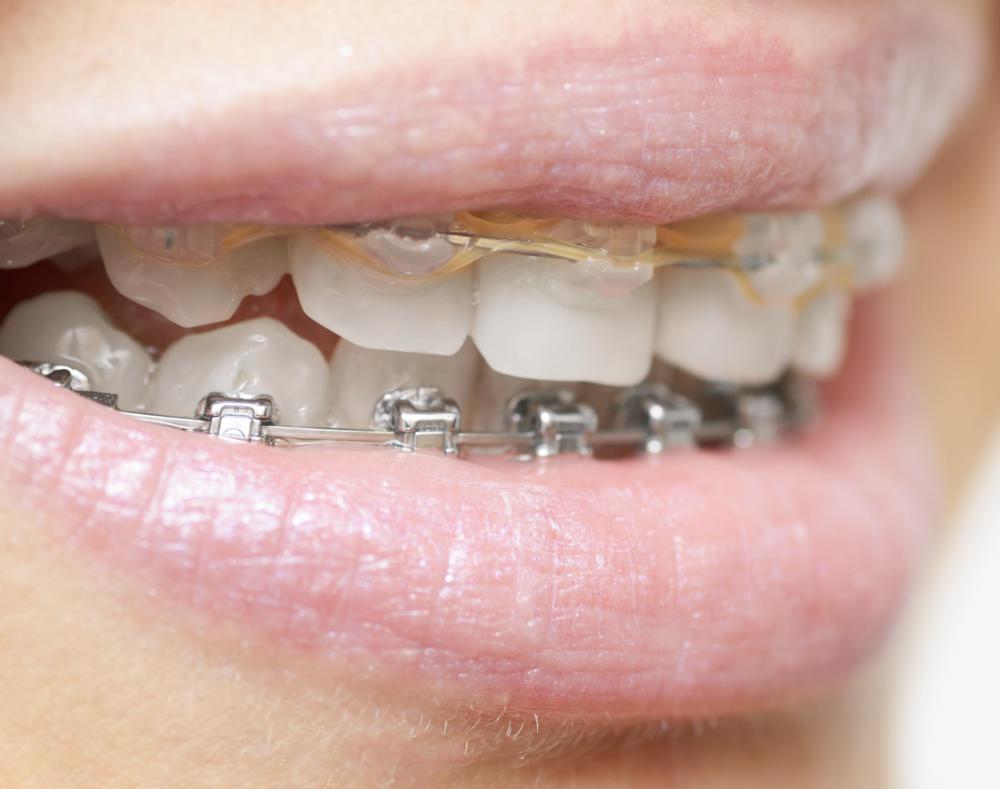 An overbite can be adjusted by an orthodontist.