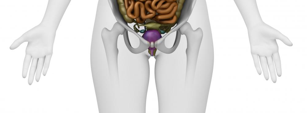 Cervical motion tenderness is often linked to pelvic inflammatory disease.