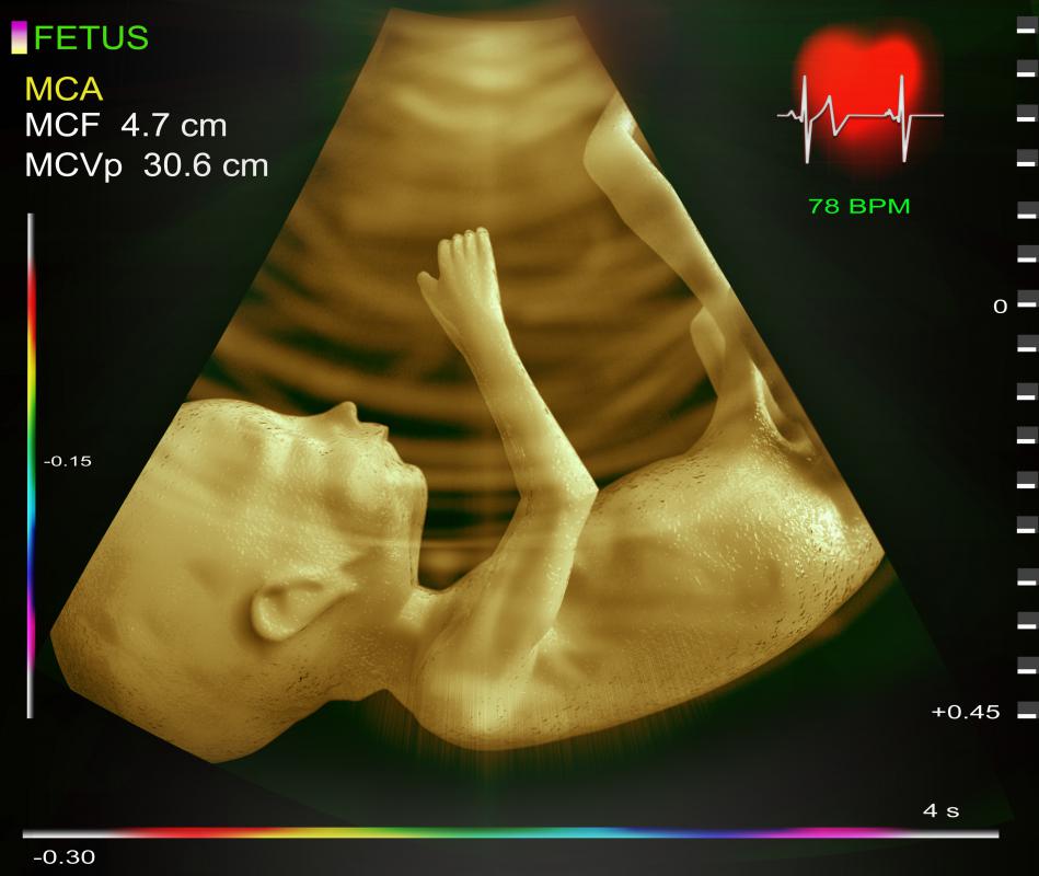 3D ultrasounds use computer programs to reconstruct a three-dimensional representation of a fetus in the womb.