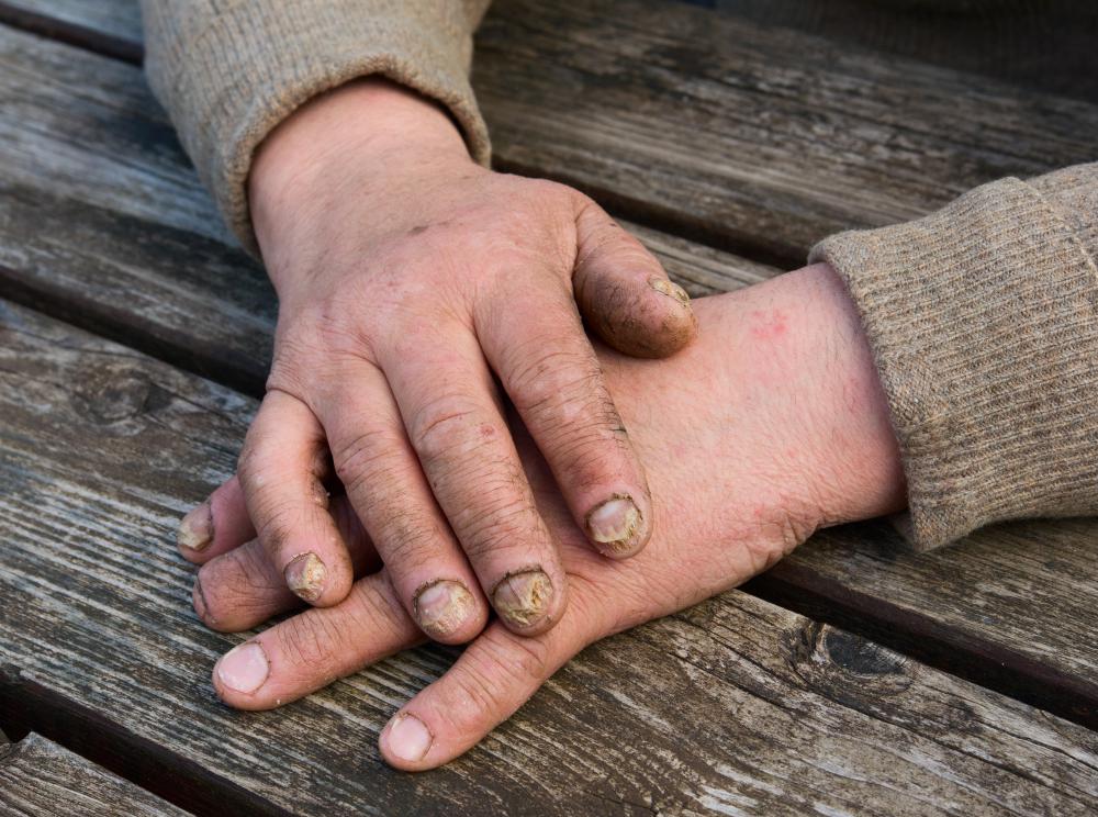White fingernails, lower left, can signal the beginning of a fungal infection, upper center.