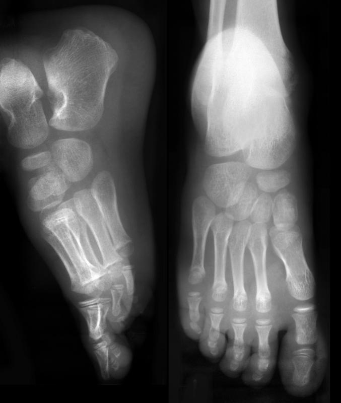 A doctor may order a foot X-ray to detect the presence of a ganglion foot cyst.