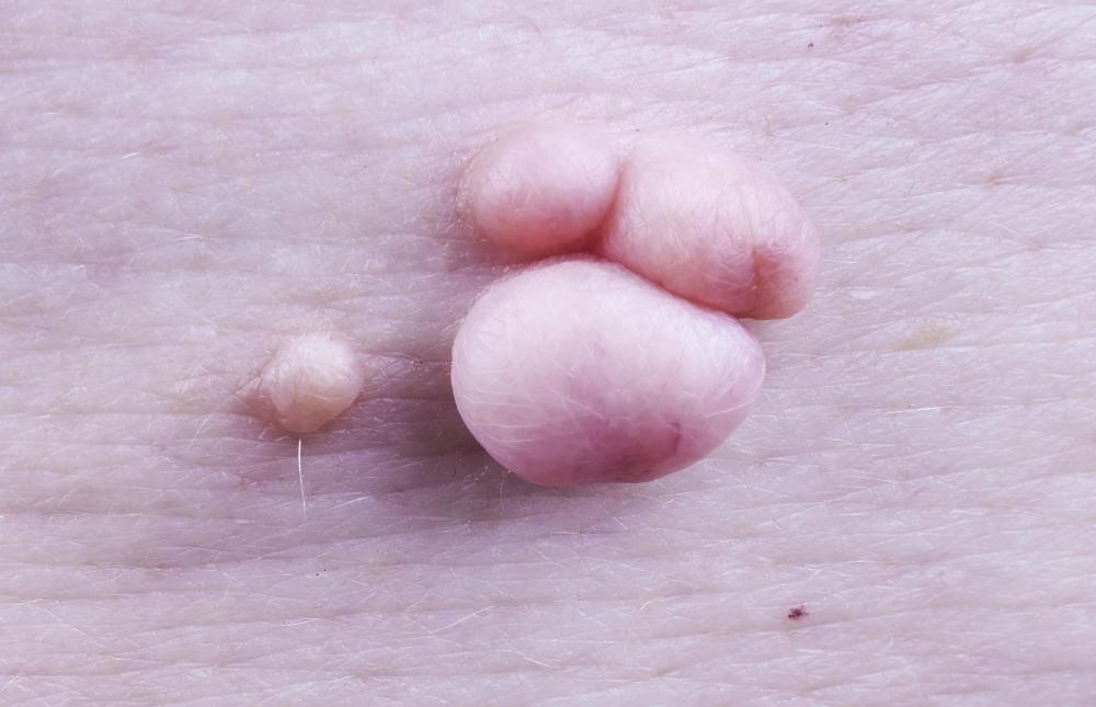 Skin tags are small growths of skin that project from a stalk-like piece of tissue.