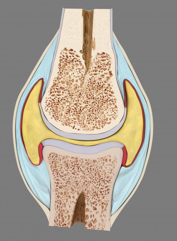 An intra-articular fracture may involve tearing cartilage.
