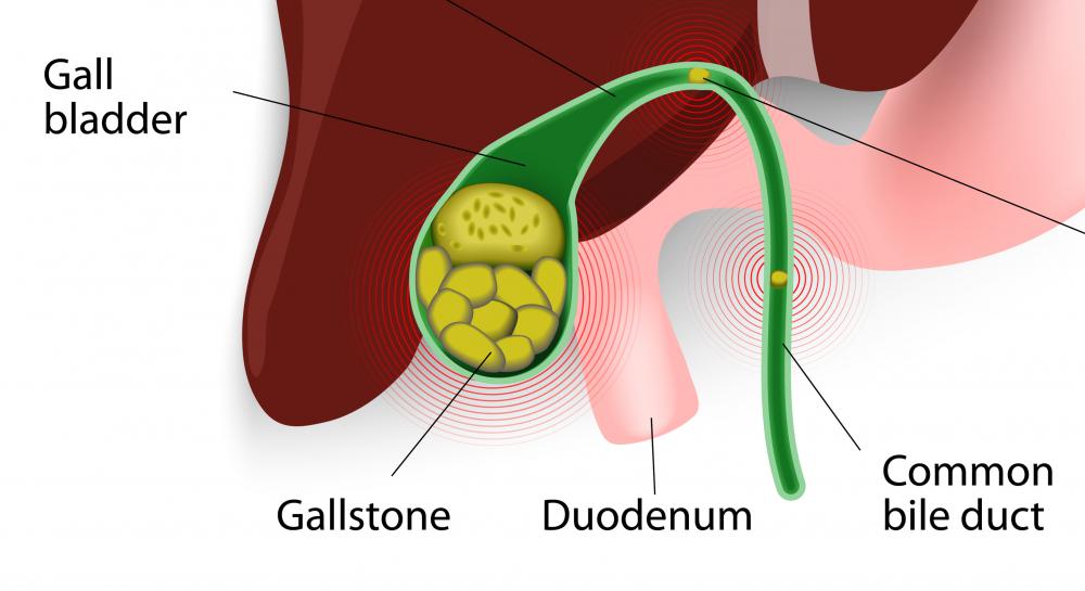 The formation of gallstones within the gallbladder may create an obstruction that impairs the flow of bile.
