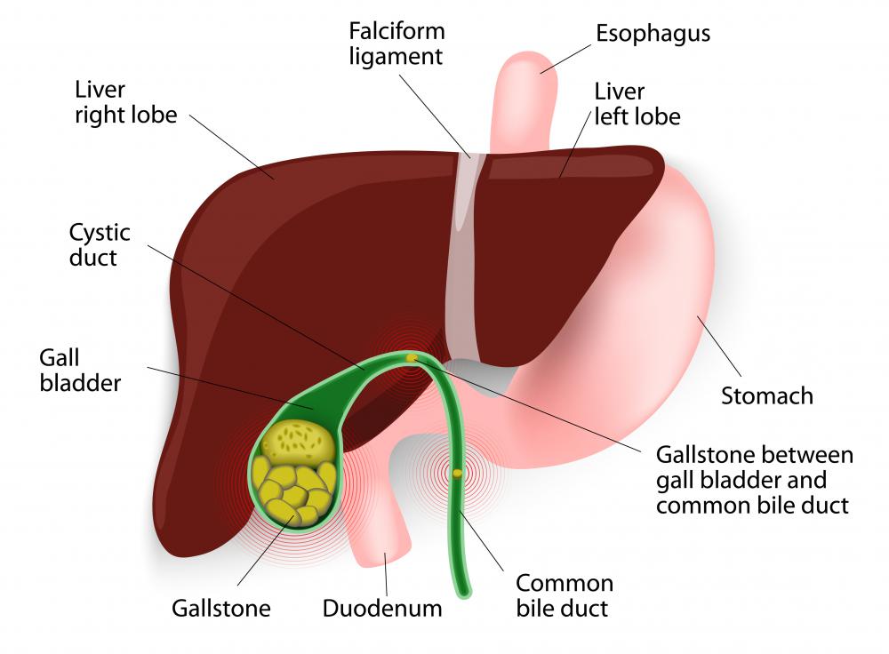 When the body produces super-saturated bile with a high ratio of cholesterol, gallstones may form.