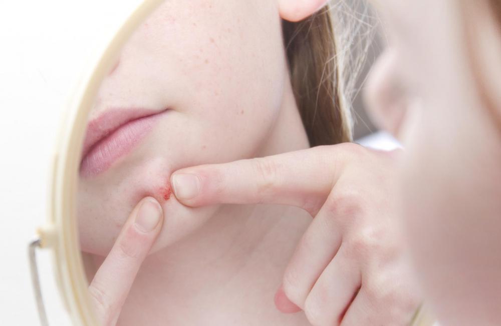 Acne is one of the most common blemish-causing conditions.