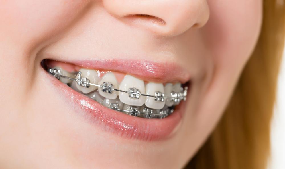 Braces are a common treatment for crooked teeth.