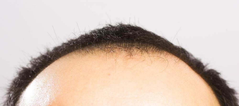 Estrogen may help slow male baldness.